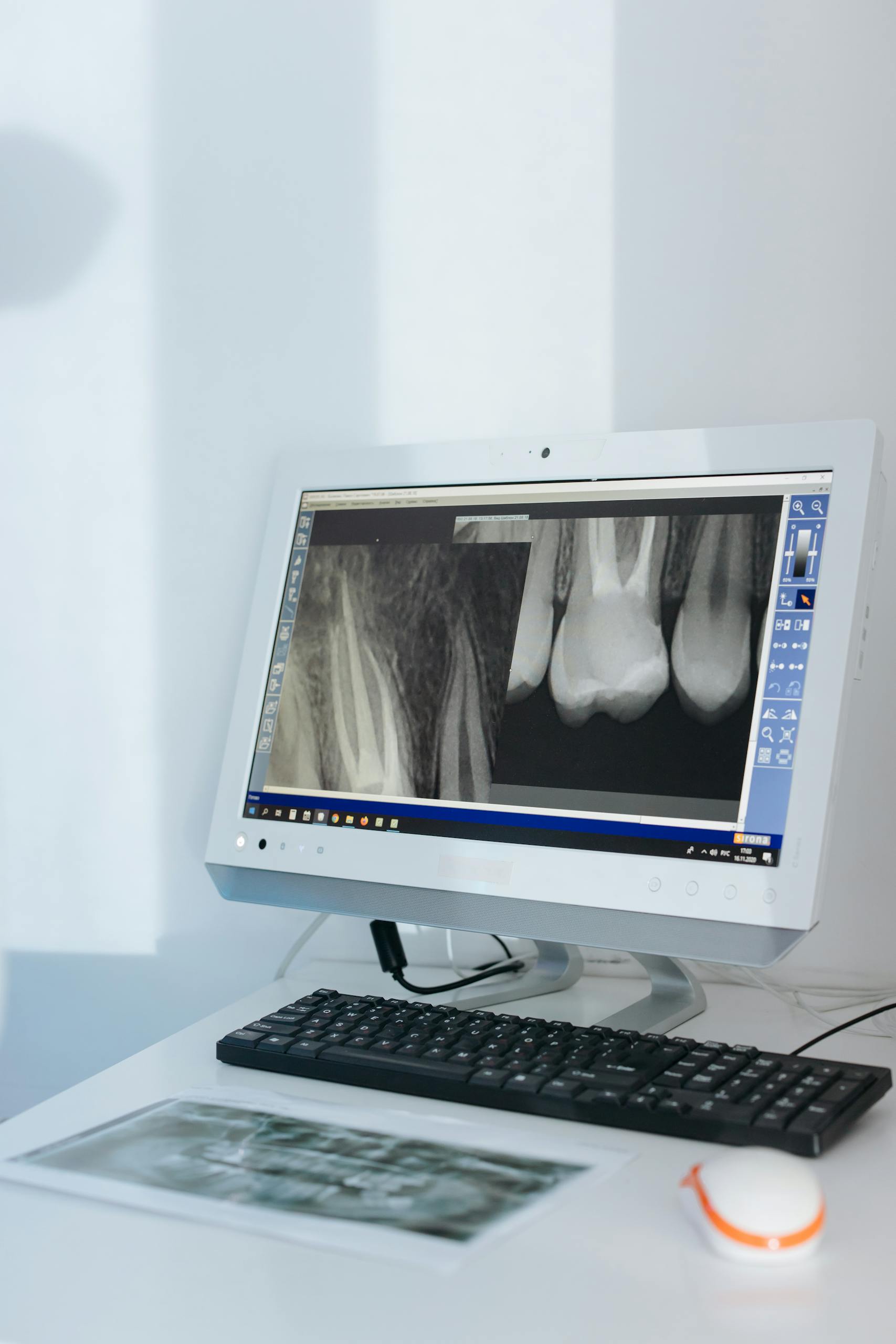 Close-up of a dental X-ray displayed on a computer monitor in a modern dental office.